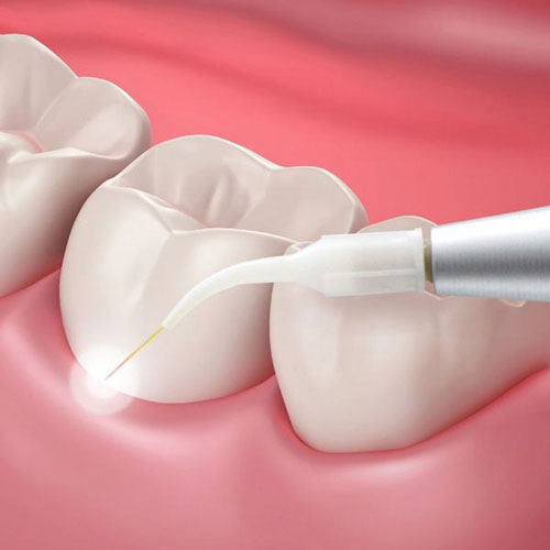 Illustration of laser gum treatment