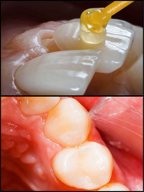 veneers and fillings