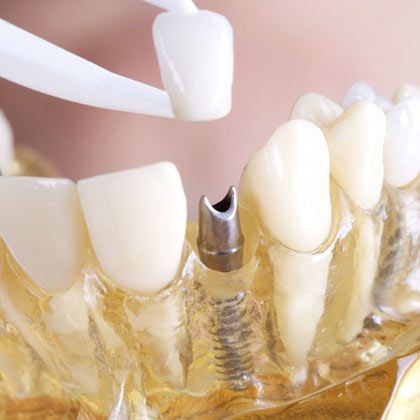 dental implants